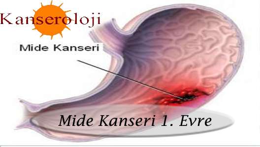 Mide kanseri erkeklerde 2 kat fazla görülüyor